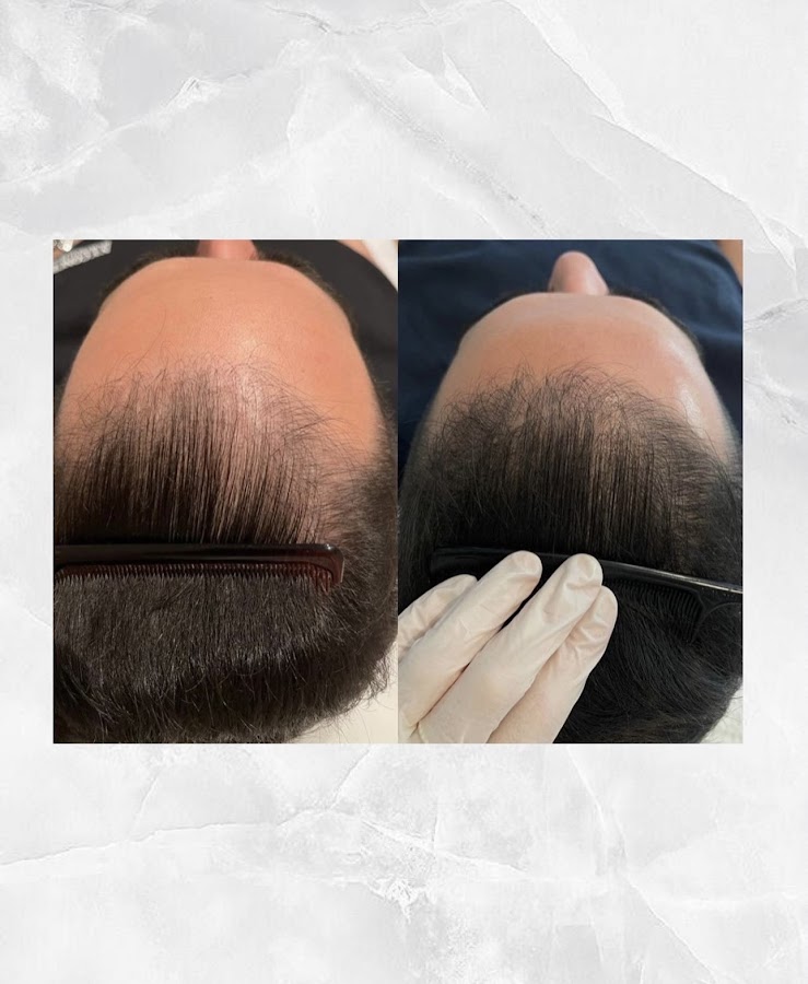 LEJOU DUBAI PRP HAIR — photo 2