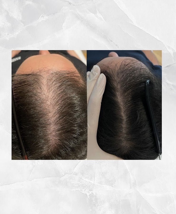LEJOU DUBAI PRP HAIR — photo 4