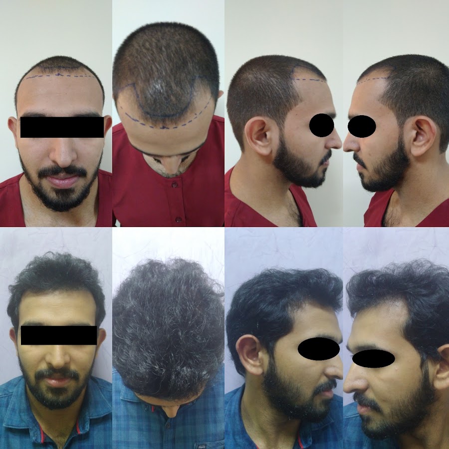 Dr. Mukesh Batra Hair Transplant — photo 3